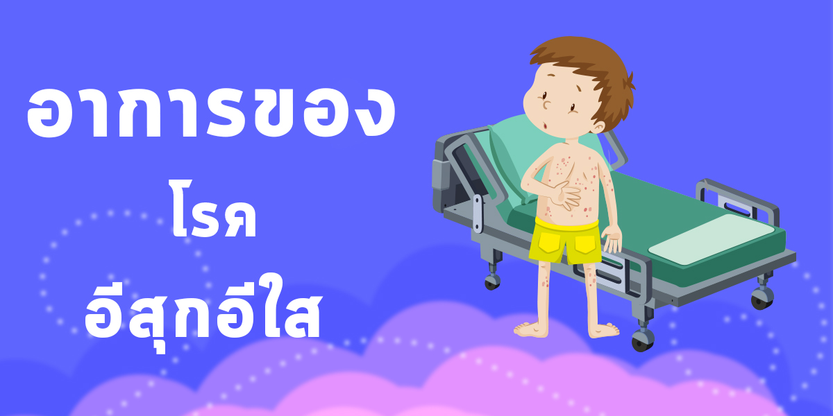 อาการของโรคอีสุกอีใส